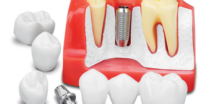 Practicon - Implant Analysis Model To Explain Treatment Options. Demonstrate Dental Bridges