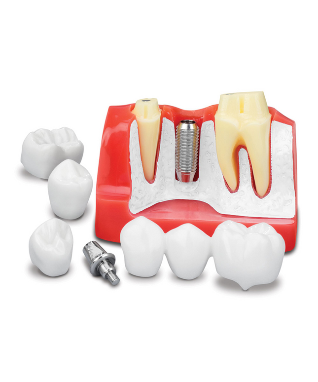 Practicon - Implant Analysis Model To Explain Treatment Options. Demonstrate Dental Bridges